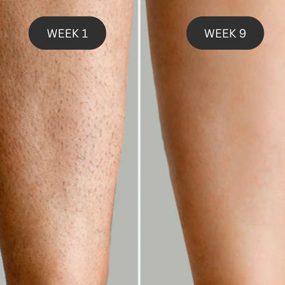IPL Laser Hair Removal Device