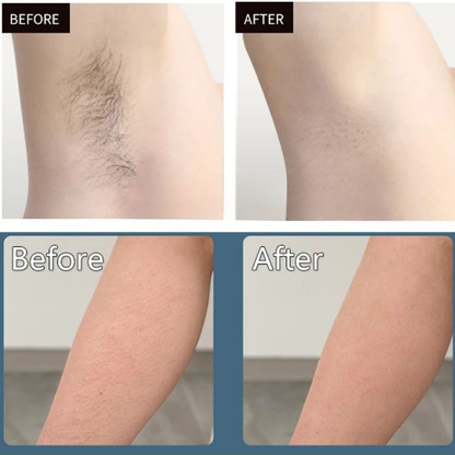 IPL Laser Hair Removal Device
