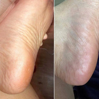 OMNX Silk 3 Pro | Electric Callus Remover — Silky Smooth Feet in Minutes