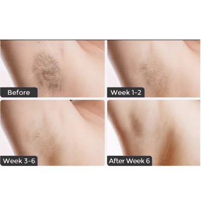 IPL Laser Hair Removal Device