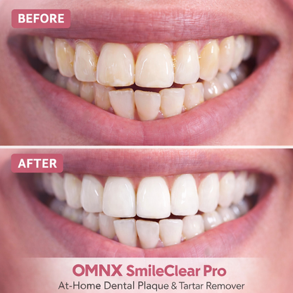 OMNX SmileClear Pro — At-Home Dental Plaque & Tartar Remover