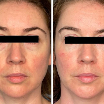 EMS Micro-Current Eye Care Device & Anti-Aging Gel Eye Patches