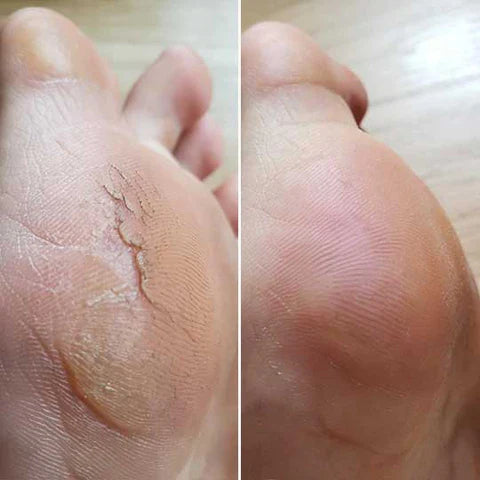 OMNX Silk 3 Pro | Electric Callus Remover — Silky Smooth Feet in Minutes