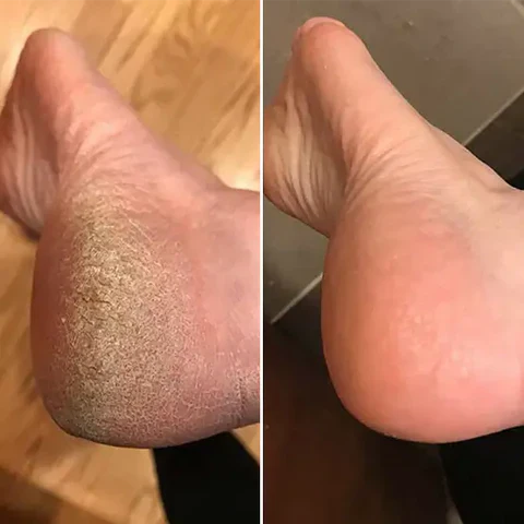 OMNX Silk 3 Pro | Electric Callus Remover — Silky Smooth Feet in Minutes