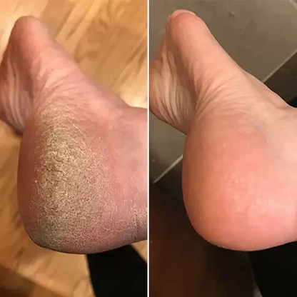 OMNX Silk 3 Pro | Electric Callus Remover — Silky Smooth Feet in Minutes