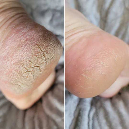 OMNX Silk 3 Pro | Electric Callus Remover — Silky Smooth Feet in Minutes