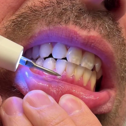 OMNX SmileClear Pro — At-Home Dental Plaque & Tartar Remover