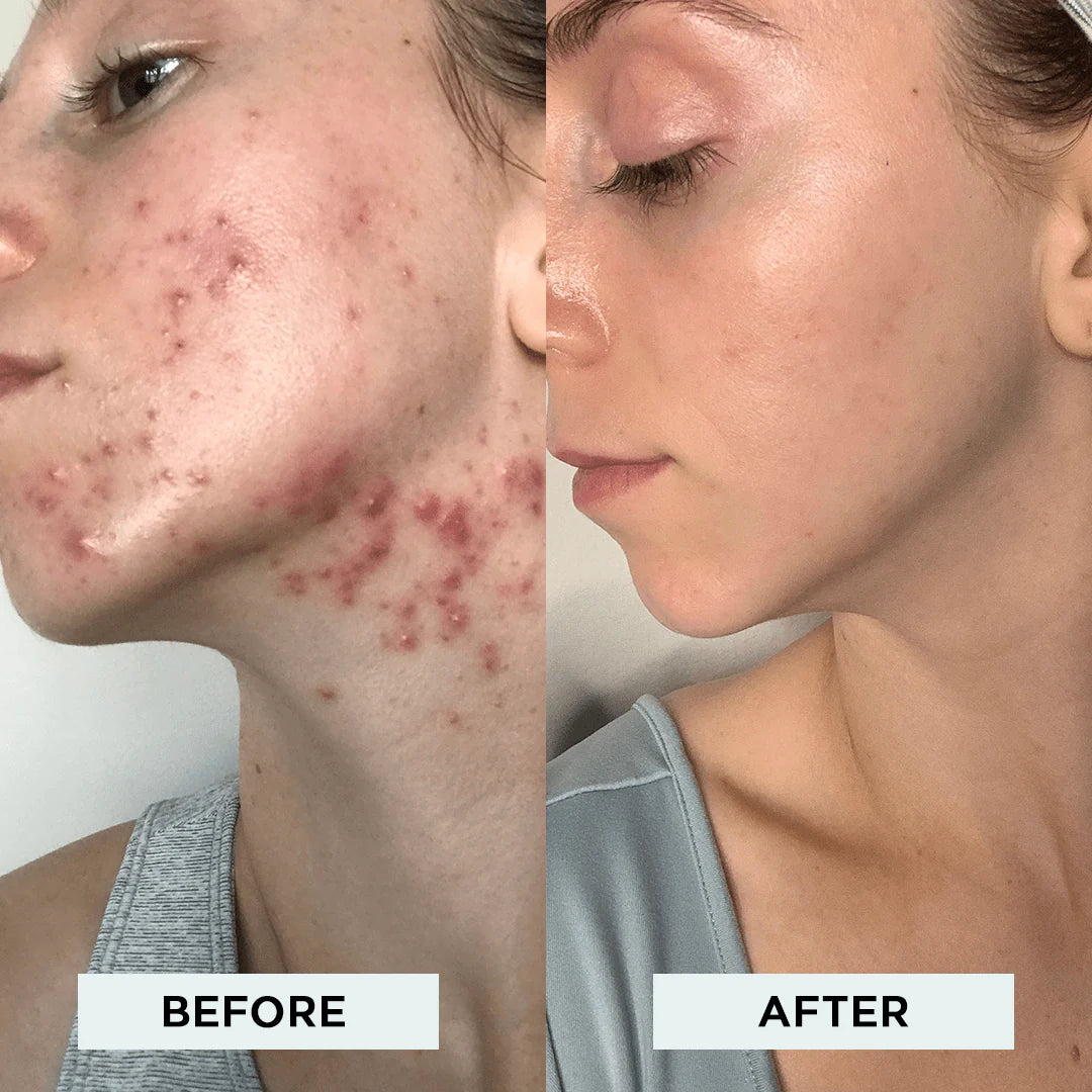 OMNX  Clinical High Frequency Wand