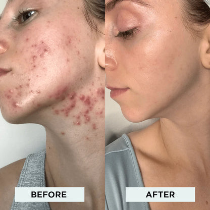 OMNX  Clinical High Frequency Wand